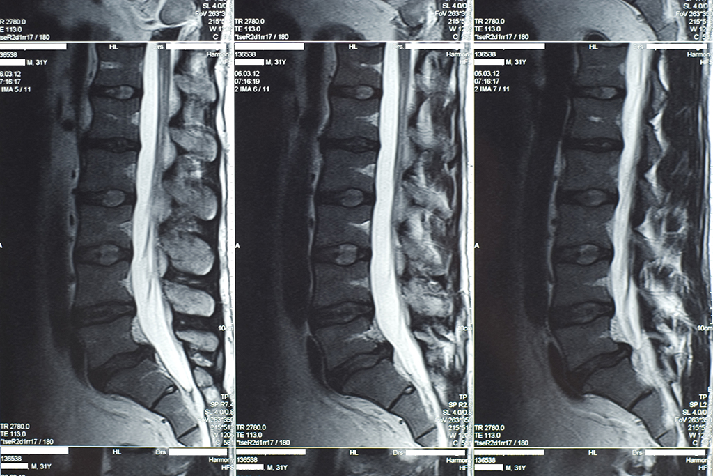 The Hidden Effects of Delaying Back Surgery