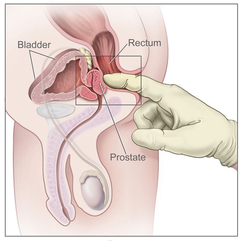 Grasping Prostate Examinations: Process and Significance