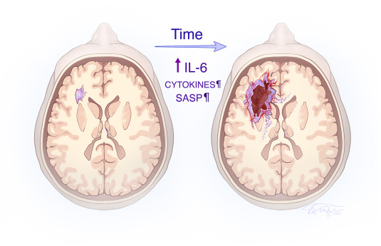 How My Stroke in Childhood Uncovered Insights into the Future of Neurosurgery and the Promise of Vagus Nerve Stimulation