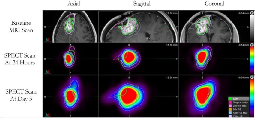 Timing Influences Patient Survival More Than Surgery