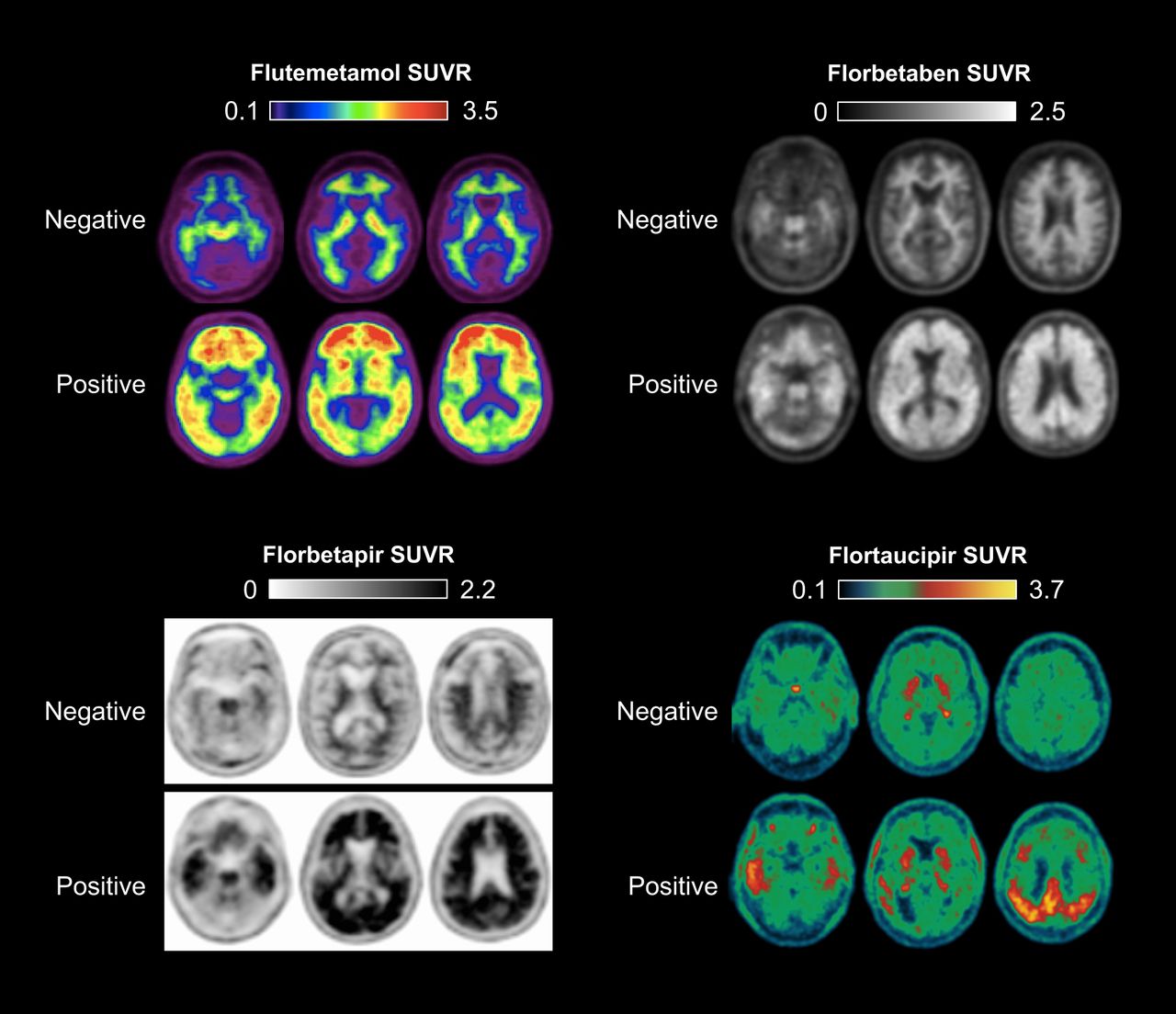 Medicaid Postpones Coverage for Alzheimer’s Blood Tests