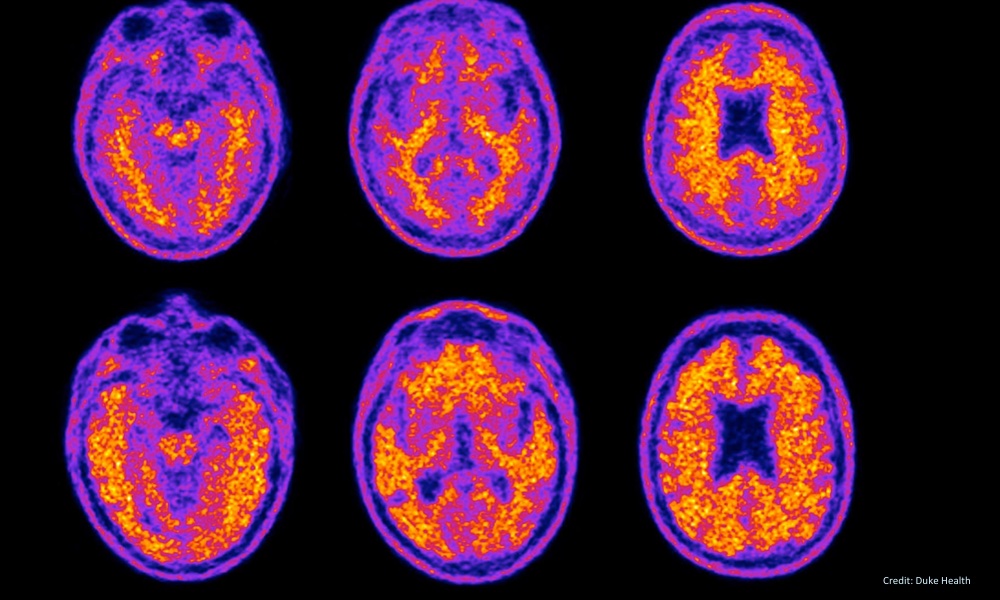The Possible Connection Between Insulin Resistance and Alzheimer's Disease