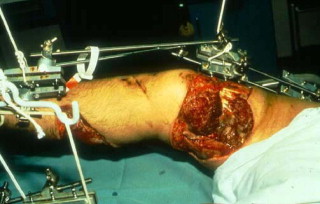 Surgical Procedure for an Impalement Trauma in the Evening