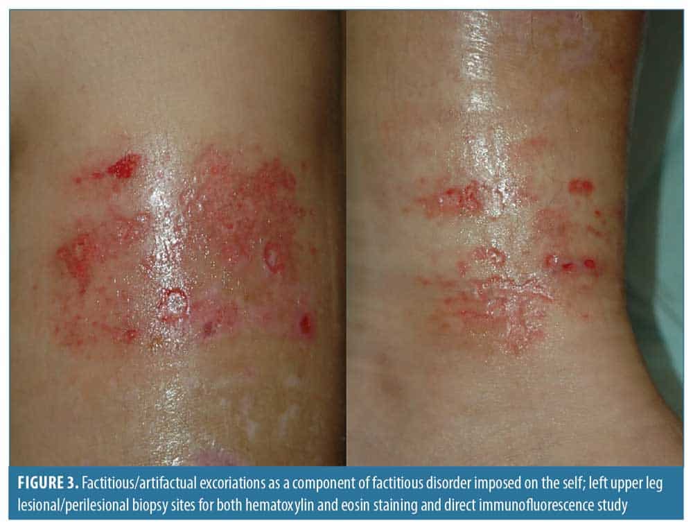 Investigating Factitious Disorder Imposed on Another: Consequences for Child Protection