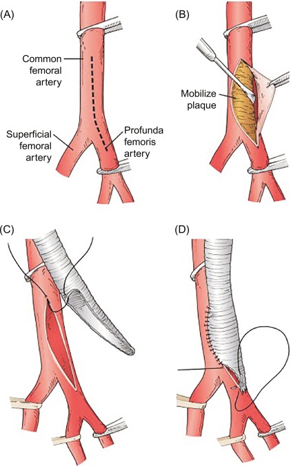 Prevention Approaches for Peripheral Artery Disease: Safeguarding Extremities and Preserving Lives
